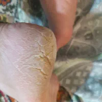 از بین بردن ترک پاشنه پا در یک جلسه  تضمینی|خدمات آرایشگری و زیبایی|شیراز, ماه فیروزان|دیوار