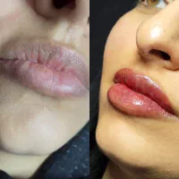 آفر ویژه شیدینگ لب فقط تا 13 فروردین ماه