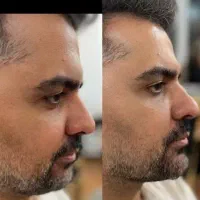 ژل و فیلرلب گونه زاویه فک کانتور نخ لیفت بوتاکس