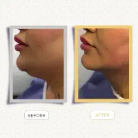 ساکشن غبغب|خدمات آرایشگری و زیبایی|رشت, گلسار|دیوار