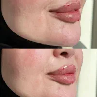 اموزش ژل  بوتاکس امپول لاغری