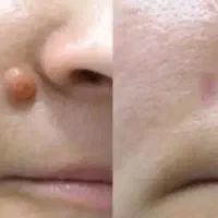برداشتن خال