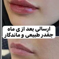 آموزش بوتاکس و فیلر (ژل)