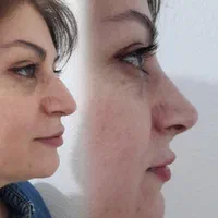 اصلاح قوزوافتادگی بینی بدون جراحی در مطب( تضمینی)