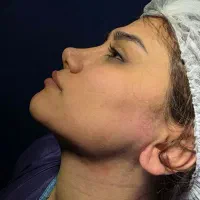 غبغب بلفارو ژل بوتاکس پیکرتراشی|خدمات آرایشگری و زیبایی|تهران, میرداماد|دیوار