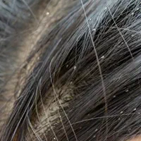 درمان صدرصدقطعی وتضمینی شپش ورشک برای همیشه|آرایشی، بهداشتی، درمانی|نورآباد, |دیوار