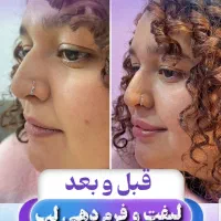 بوتاکس ژل لیفت بانخ ودوسوزنه وکاگ ژل زیرچشم صادقیه