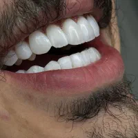 استخدام کامپوزیت کار خانم محمدشهر