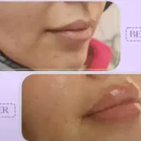 جشنواره عیدانه تزریق ژل و بوتاکس و لاغری در کلینیک|خدمات زیبایی و سلامت|تبریز, |دیوار