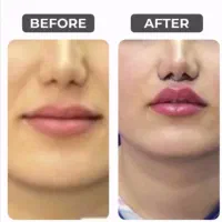 خدمات زیبایی توسط متخصص بلفارو بوتاکس لیفت زاویه|خدمات آرایشگری و زیبایی|اصفهان, گلزار|دیوار