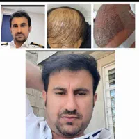 کاشت مو طبیعی،ابرو،و ریش بدون ورم و حتی کبودی|خدمات آرایشگری و زیبایی|یاسوج, |دیوار