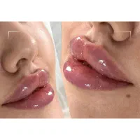 تزریق ژل ،فیلر ، بوتاکس ، مزوژل و نخ لیفت
