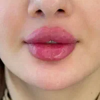 جشنواره تزریق ژل بوتاکس(قیمت پایین کیفیت بالا)|خدمات آرایشگری و زیبایی|اصفهان, جلفا|دیوار