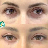 بلفارو پلک بالا و پایین/ روشهای نوین لاغری