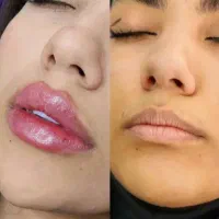 تزریق ژل و بوتاکس|خدمات آرایشگری و زیبایی|اهواز, نادری|دیوار