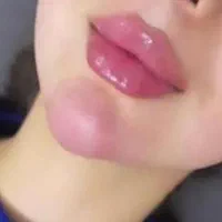 ژل بوتاکس مزو فیلر انزیم فیلر فشیال|خدمات آرایشگری و زیبایی|اسلامشهر, مطهری|دیوار