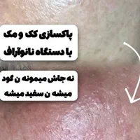 خالبرداری پلاسما درمان ککُ مک و منافذ فیشیال تخصصی|خدمات آرایشگری و زیبایی|مرودشت, گندم‎|دیوار