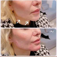 تزریق ژل و بوتاکس هایفو فیلربادی|خدمات آرایشگری و زیبایی|تهران, عبدل‌آباد|دیوار