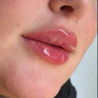مزو بوتاکس فیلر ژل