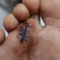 سفید کننده بدن رسید