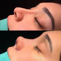 جراحی بینی|خدمات آرایشگری و زیبایی|کرج, عظیمیه|دیوار