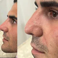 ژل اودری اصل سی سی 350بوتاکس ۵۰۰و خال برداری|خدمات آرایشگری و زیبایی|قم, زنبیل آباد|دیوار