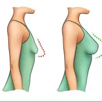 پروتز سینه+اقساطی ویژه(ظرفیت محدود)