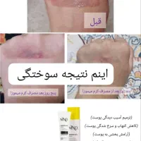 کرم حاوی %10 میموزا مناسب انواع پوست ام ان دی|آرایشی، بهداشتی، درمانی|تبریز, |دیوار