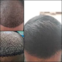 کاشت مو شیرازی
