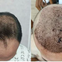 کاشت مو و ابرو