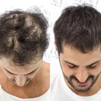 راهنمایی و مشاوره رایگان ریزش مو