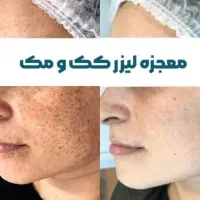 جشنوار یلدا درمان تضمینی کک ومک/لک/خال/فقط در1جلسه|خدمات آرایشگری و زیبایی|اصفهان, باغ زیار|دیوار