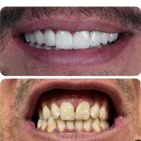 دندانپزشکی/ کامپوزیت زیبایی/ لمینت/دندان مصنوعی|خدمات آرایشگری و زیبایی|تهران, نعمت‌آباد|دیوار
