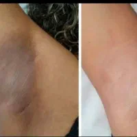 لیزر مو زائد دستگاه تیتانیوم آلما اصل۶تا۸جلسه۸۹۰
