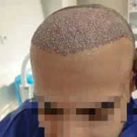 کاشت مو ماریا ایلخانی پور