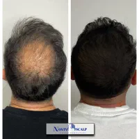 رفع کم پشتی مو با میکرو اسکالپ/ جایگزین کاشت مو|خدمات آرایشگری و زیبایی|مشهد, وکیلآباد|دیوار