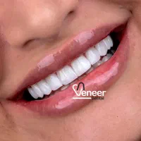 کامپوزیت دندان رایگان  ،لمینت ( اقساط ۱۵ ماه)|خدمات آرایشگری و زیبایی|تهران, الهیه|دیوار