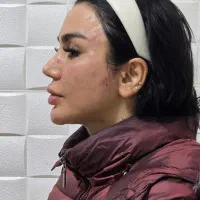 تزریق فیلر بادی برای باسن پروتز سینه لیفت صورت