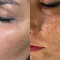 درمان قطعی لک