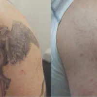 جشنواره لیزر ریموو تتو و موی زائد در مطب پزشک