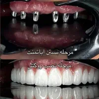 مرکز تخصصی دندانپزشکی ایمپلنت آلمانی(اقساط ۱۲ماهه)|خدمات آرایشگری و زیبایی|تبریز, |دیوار