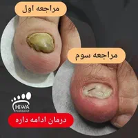 درمان بیماری ناخن و ارتونیل (پودولوژی)|خدمات آرایشگری و زیبایی|اصفهان, سعادت‌آباد|دیوار