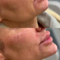 مزوتراپی  .روشن کننده .جوانساز . فیلر