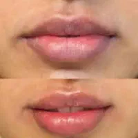 تخفیف ویژه کربن تراپی با پیشرفته ترین دستگاه|خدمات آرایشگری و زیبایی|اهواز, کیانپارس |دیوار