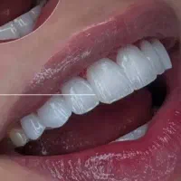 توروخداراهنمایی کنید ایمپلنت باکیفیت وقیمت مناسب