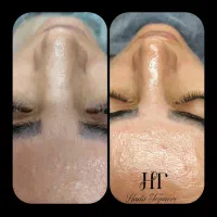 تخفیف ویژه فیشال تخصصی با مواد تانورا تایک هفته|خدمات آرایشگری و زیبایی|مشهد, طرق|دیوار