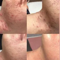 پاکسازی تخصصی پوست کره ای زیر قیمت (خانم وآقا)