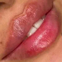 خدمات ژل و بوتاکس ، مزوتراپی سر و صورت|خدمات آرایشگری و زیبایی|شاهینشهر, فردوسی|دیوار