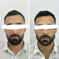کانتور و فیلر و بوتاکس اقاو‌خانوم مدل رایگان|خدمات آرایشگری و زیبایی|هشتگرد, شهرک ولیعصر (مصلی)|دیوار