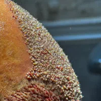 کلینیک تخصصی کاشت مو و ابرو در رشت